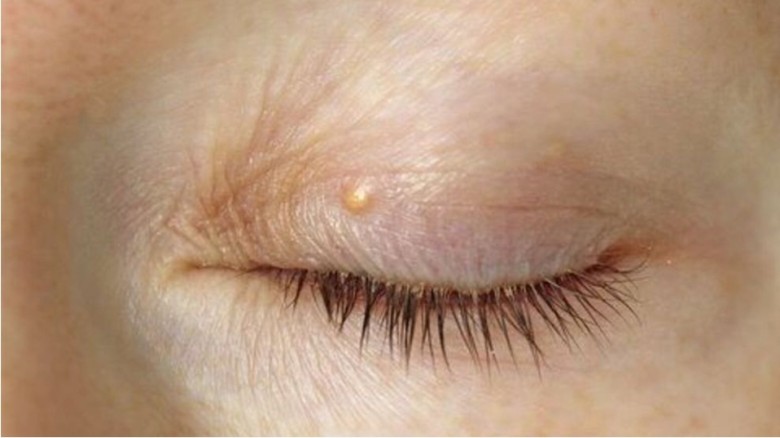 চোখ দেখে হার্ট অ্যাটাকের ঝুঁকি চেনার ৪ লক্ষণ...